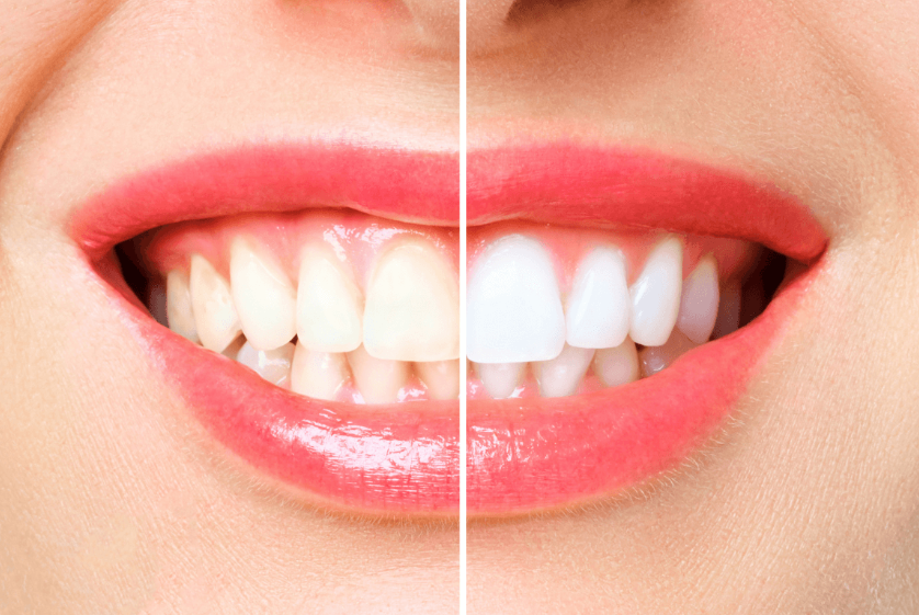 How Long Professional Teeth Whitening Results Last and Why
