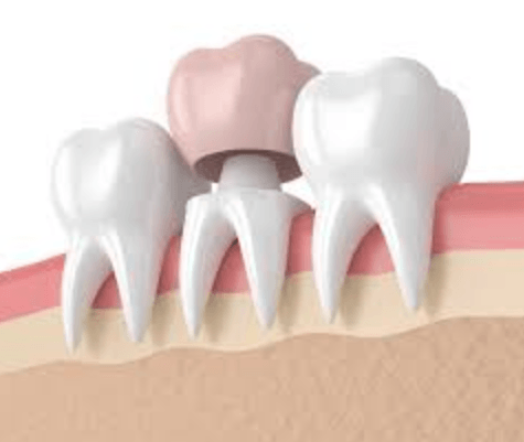 Crown Lengthening: When Periodontists Reshape Gum And Bone For Restorations