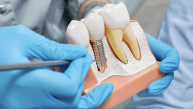 3 Common Myths About Oral Surgery And Dental Implants