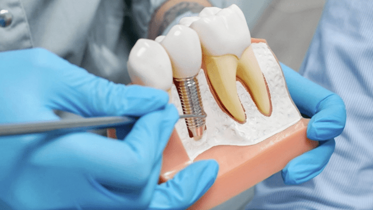 3 Common Myths About Oral Surgery And Dental Implants
