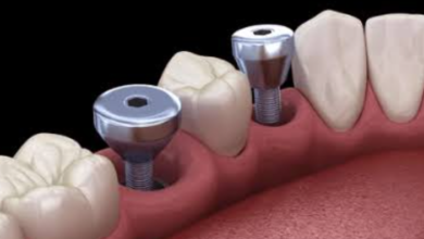 Healing Caps And Abutments: The Small Parts That Make Dental Implants Work