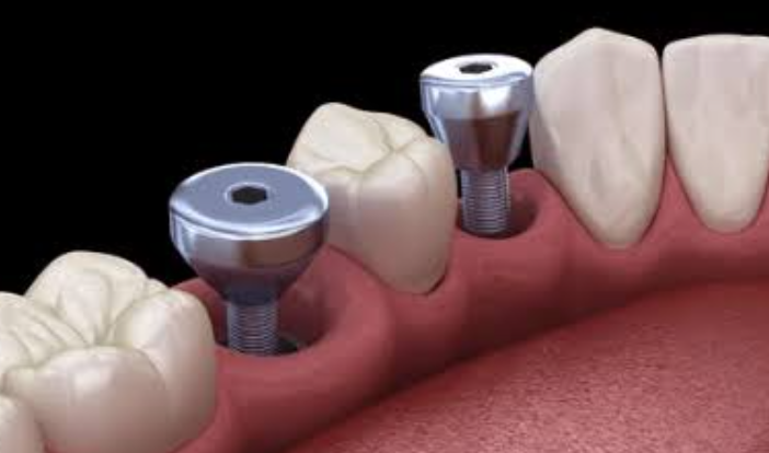 Healing Caps And Abutments: The Small Parts That Make Dental Implants Work