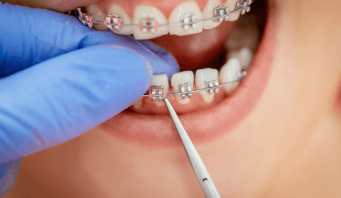 Broken Braces And Orthodontic Emergencies: