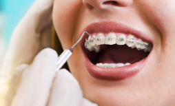 3 Common Myths About Orthodontic Braces Debunked
